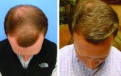 B-Metro Experts: T3 Hair Restoration, Michael Beckenstein MD
