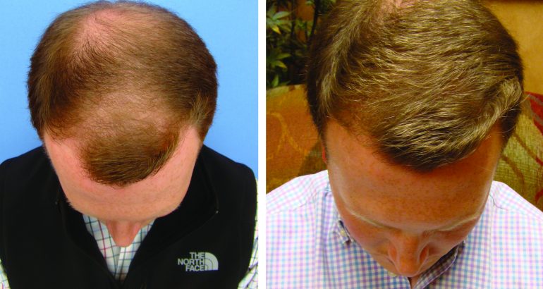 B-Metro Experts: T3 Hair Restoration, Michael Beckenstein MD